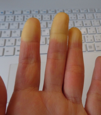 Raynaud-Syndrom und Schlaf — kalte Hände und Füße in der Nacht verstehen und wirksam gegensteuern Raynaud-Syndrom und Schlaf — kalte Hände und Füße in der Nacht verstehen und wirksam gegensteuern