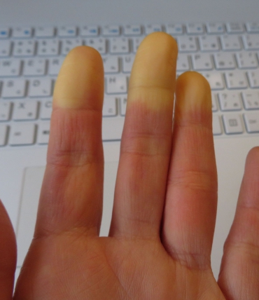 Raynaud-Syndrom und Schlaf, und warum nachts Hände und Füße kalt werden und wie man dagegen vorgeht